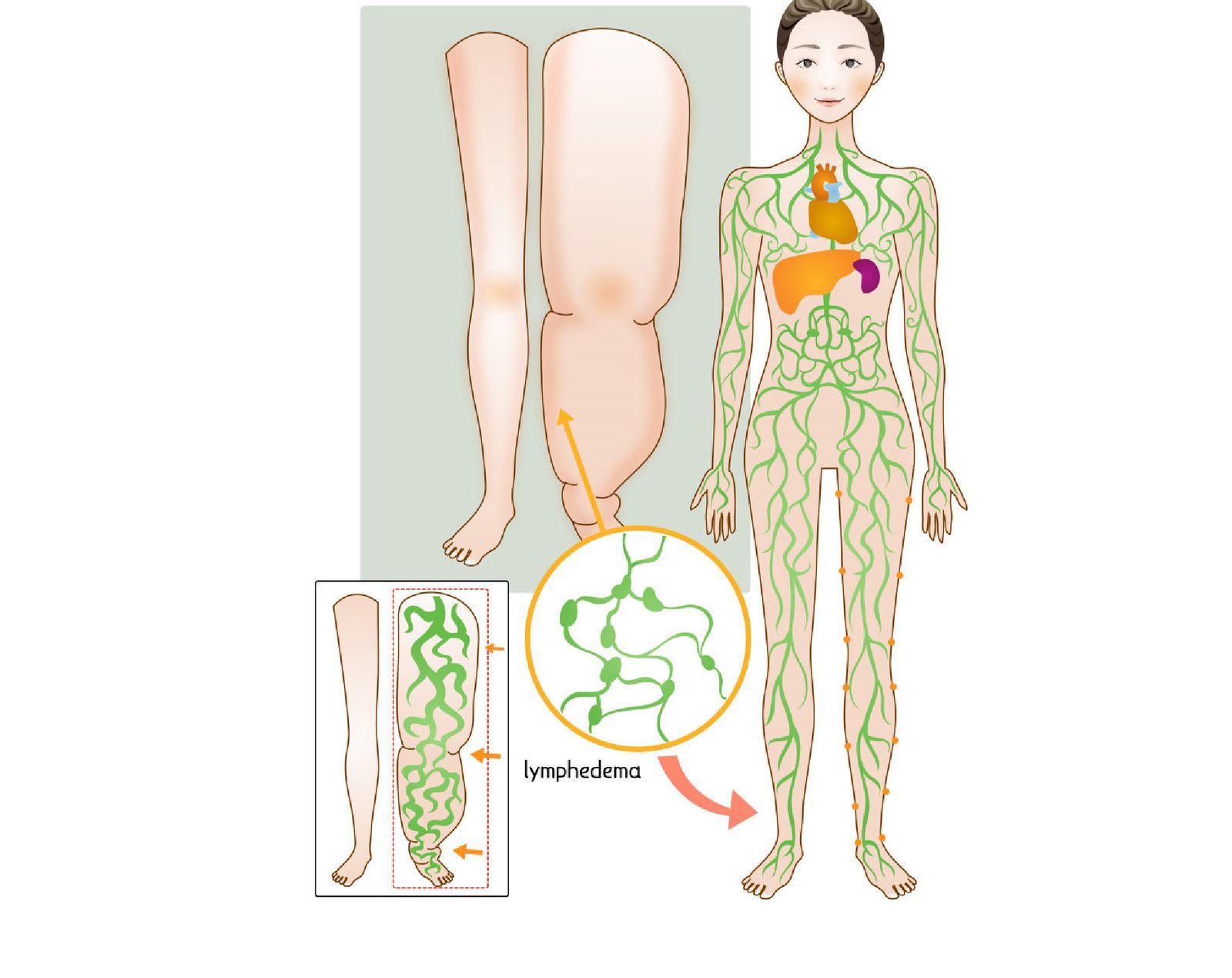 림프부종으로 부은 다리와 전신 림프계 일러스트